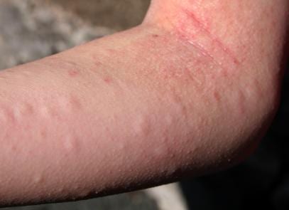 অতিরিক্ত ড্রাগন ফল খাওয়ার ফলে অ্যালার্জি হতে পারেঃ