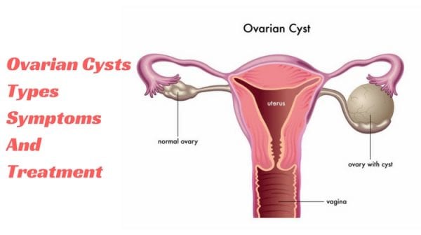 ওভারি সিস্ট