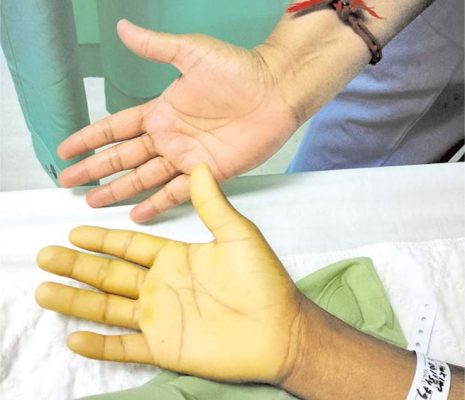দীর্ঘদিন ধরে জন্ডিস শরীরে থাকলে লিভার ক্যান্সার হতে পারেঃ