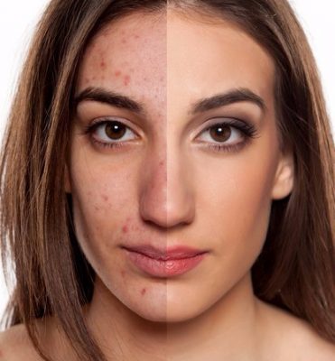 ব্রণ, এবং পিম্পল দূর করতে আপেল সাইডার ভিনিগারের উপকারিতাঃ