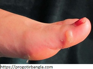 ফোস্কা কী? (What is Blister)