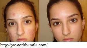 ব্রণ দূর করতে হলুদ ব্যবহারের টিপস