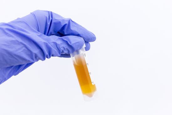 Dark coloured urine in a sample bottle