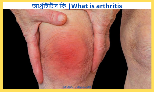 আর্থ্রাইটিস কি