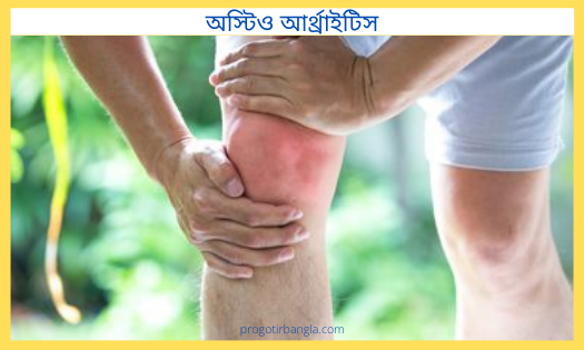 অস্টিও আর্থ্রাইটিস