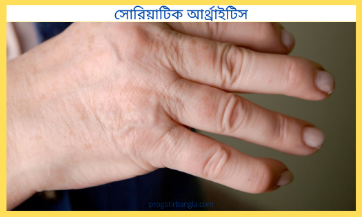 সোরিয়াটিক আর্থ্রাইটিস