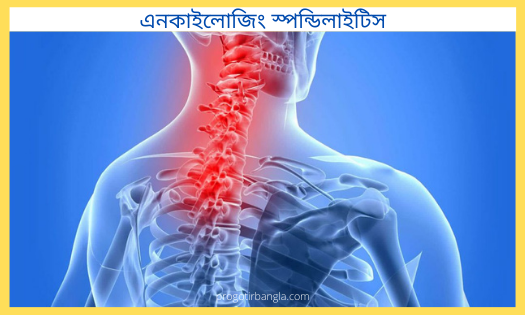 এনকাইলোজিং স্পন্ডিলাইটিস