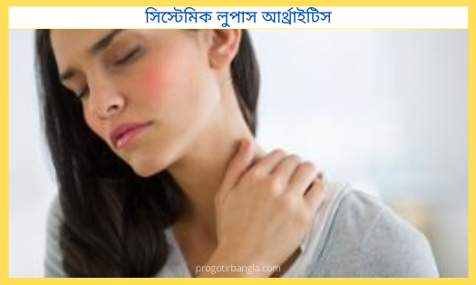 সিস্টেমিক লুপাস আর্থ্রাইটিস