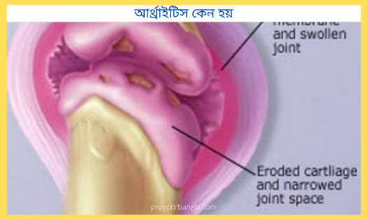 আর্থ্রাইটিস কেন হয়